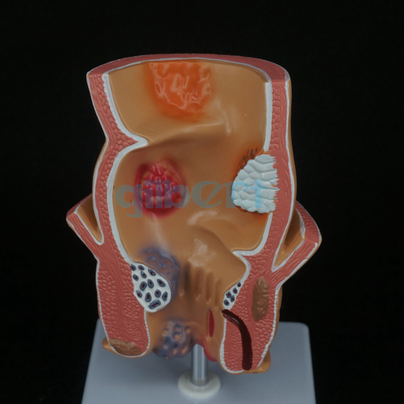 Anatomical Human Rectum Pathology Lesion Model Hemorrhoids Anus Medical Learning