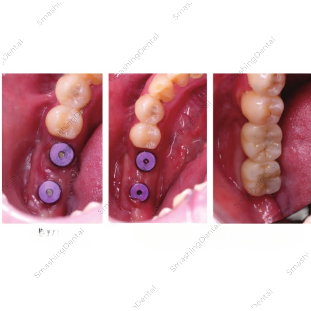 Dental Healing Abutment Healing Closure RC/NC Fit Straumann ITI Bone Level