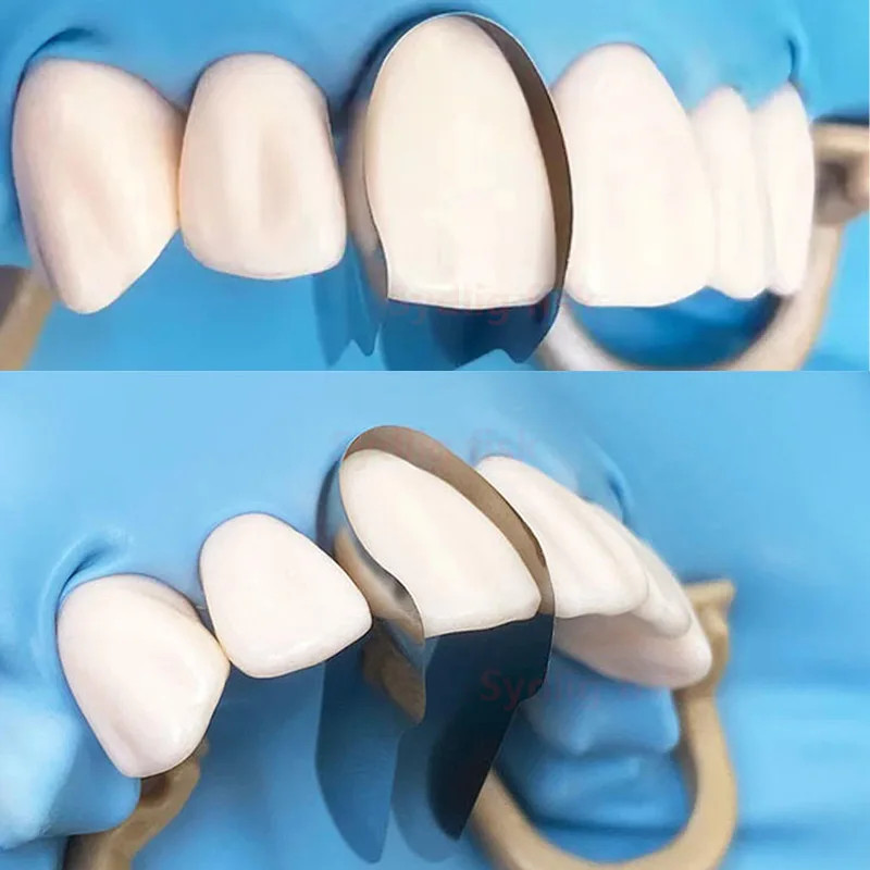30x Dental Anterior Matrix Bands Proximal Anterior Strips Twin Anterior Matrices