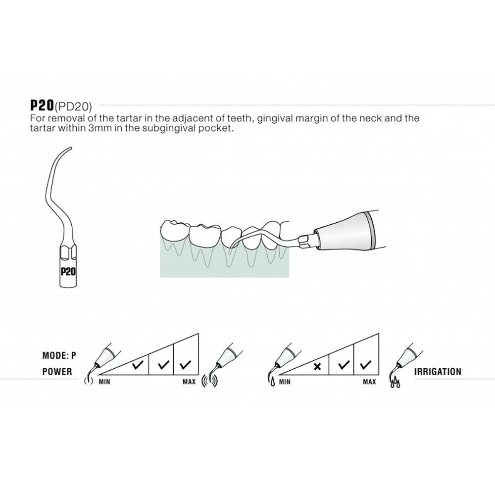 Woodpecker P20 Ultrasonic Scaler Tips for Woodpecker EMS Cavitron, 5pcs/Pack